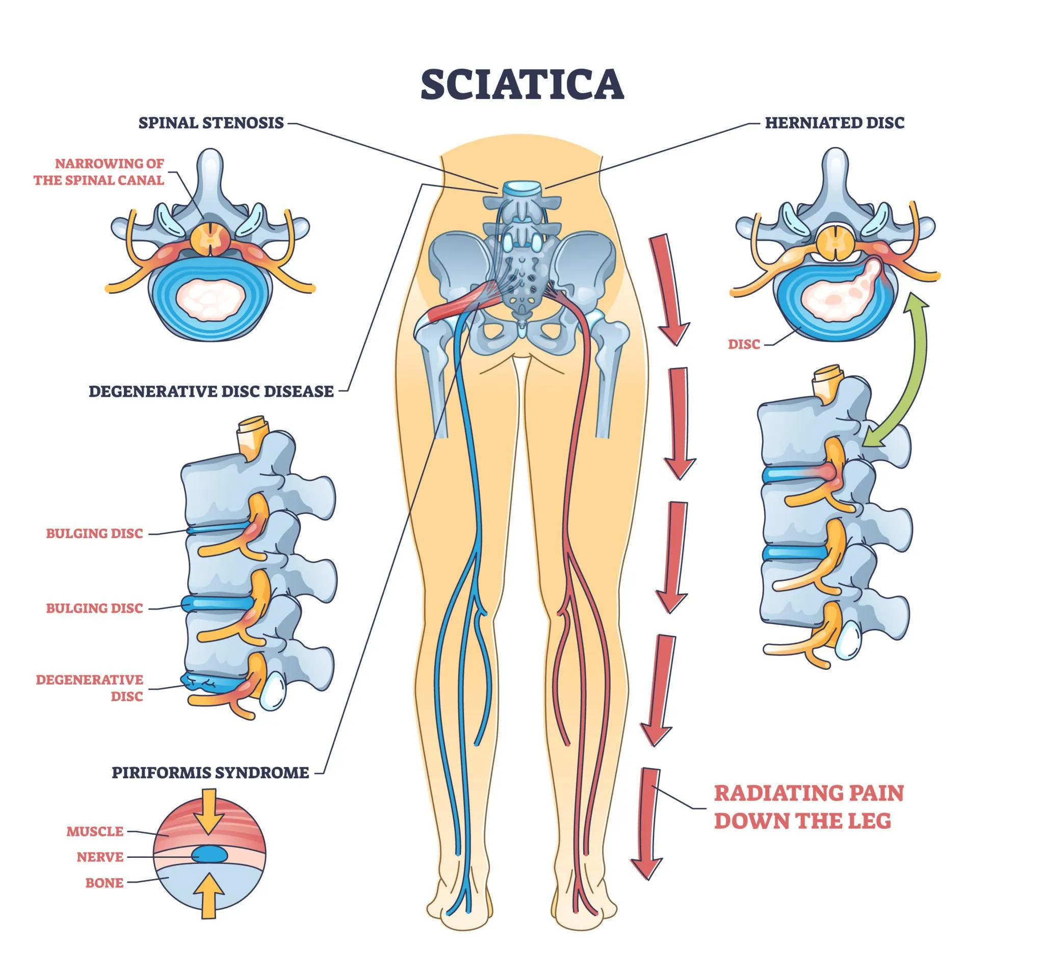 Anatomical diagram showing sciatic nerve irritation and causes.