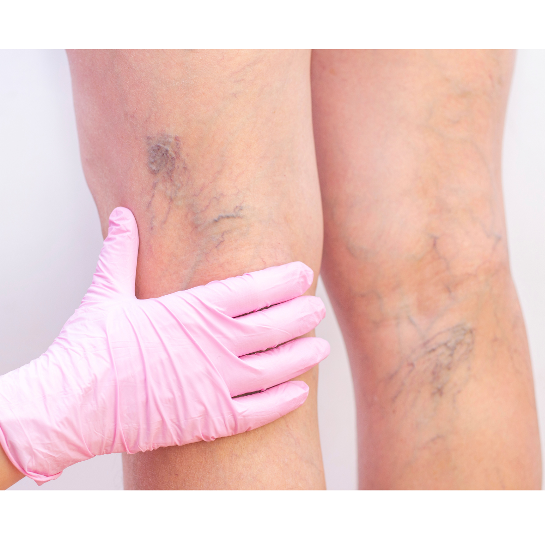 Poor circulation, swelling, varicose veins, and spider veins