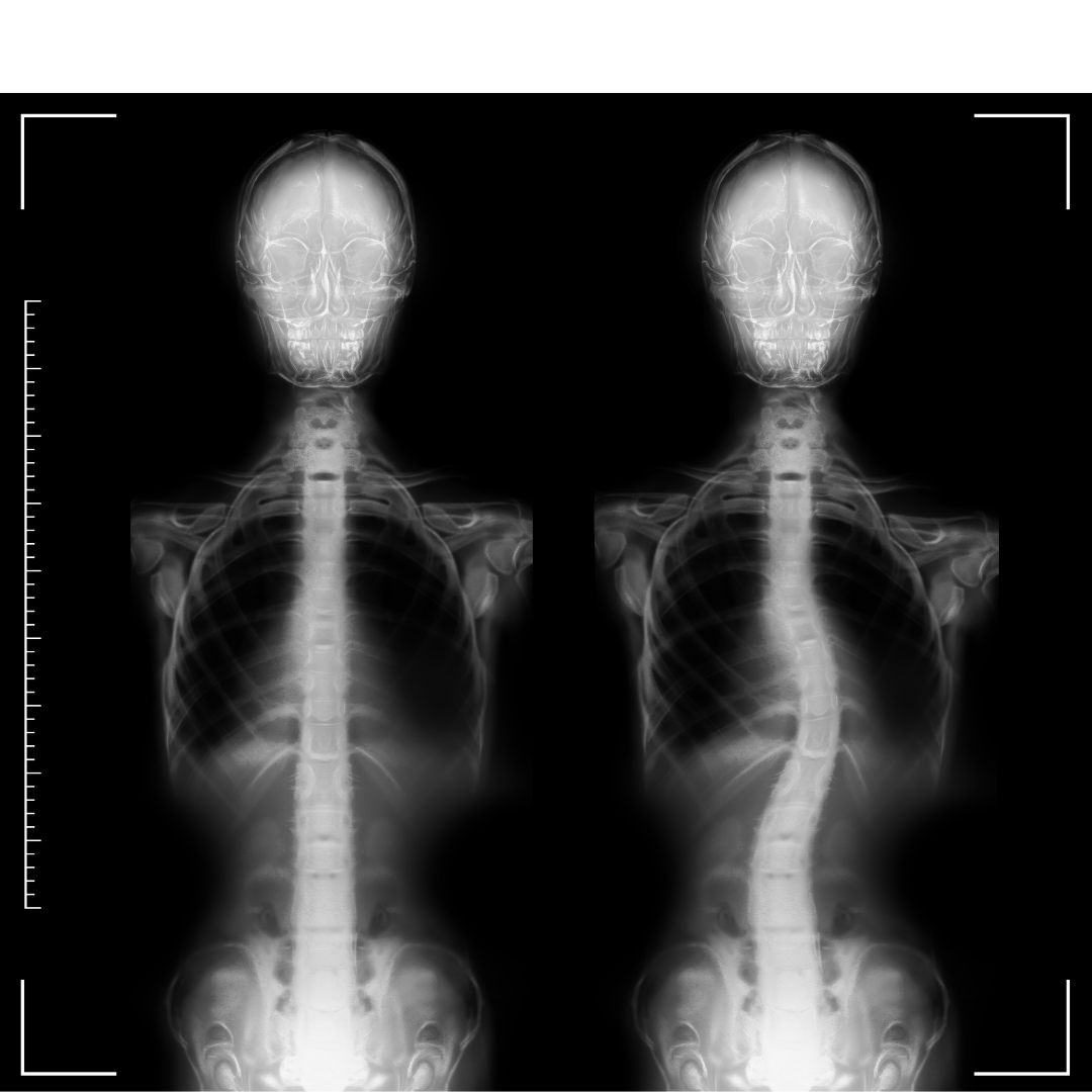 Scoliosis